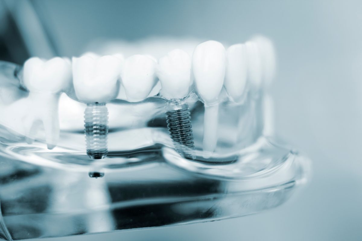Dental implants in Austin TX at 12 Oaks Integrative Dentistry