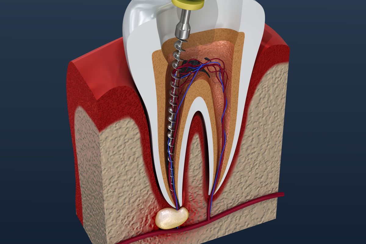 Root canal treatment in Austin TX at 12 Oaks Integrative Dentistry